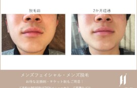 ひげ脱毛before-after